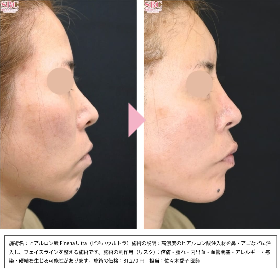 ピネハウルトラ《症例集》